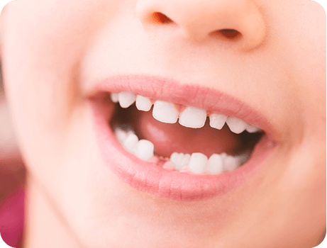 乳歯から永久歯へのスムーズな移行を促す